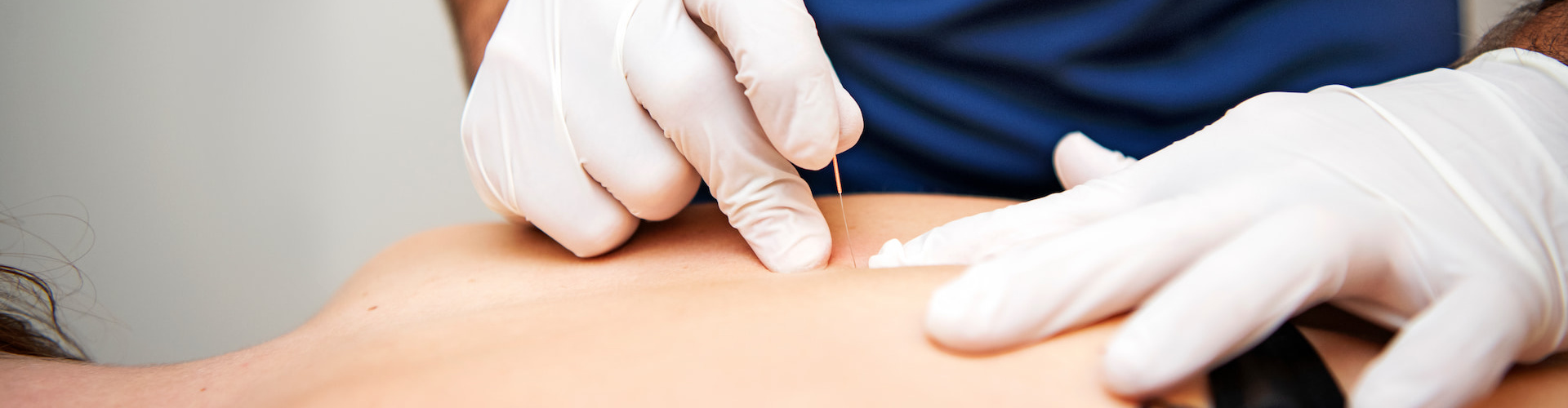 Dry needling Groningen bij aanhoudende spierklachten