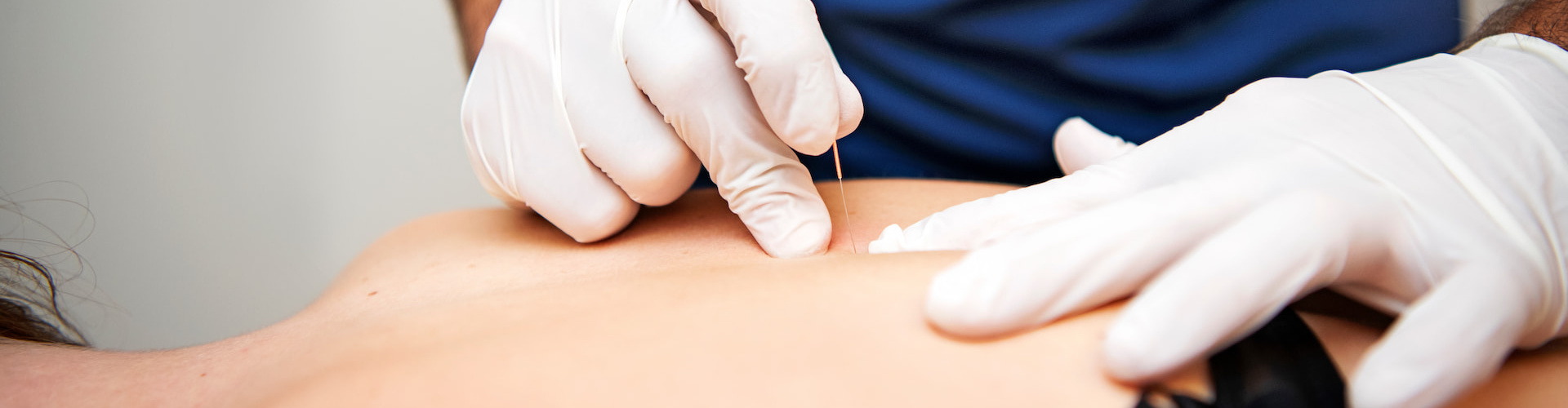 Wat is dry needling?