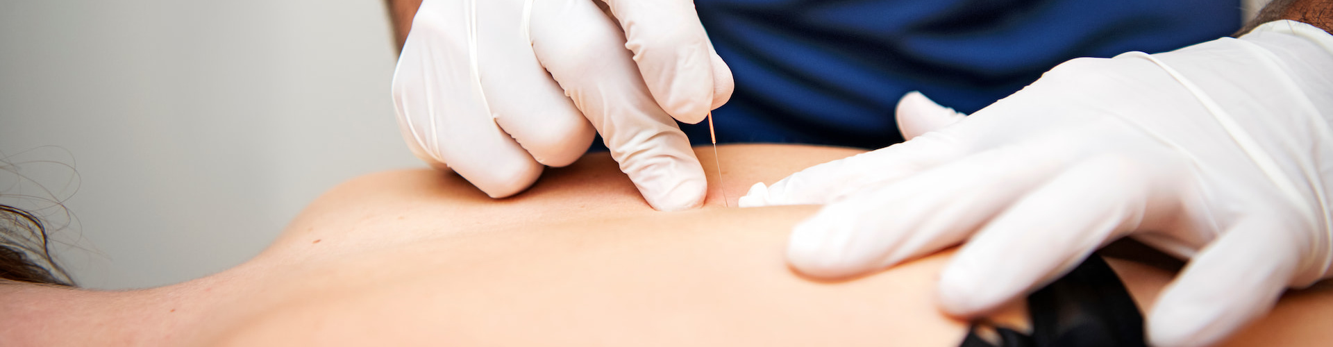 Dry needling bij aanhoudende rugklachten