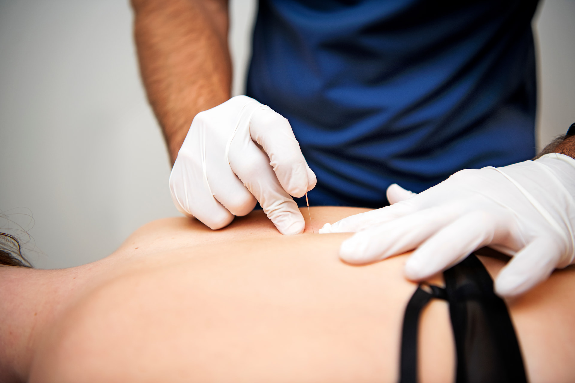 Dry needling bij aanhoudende rugklachten